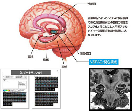 VSRADの説明図